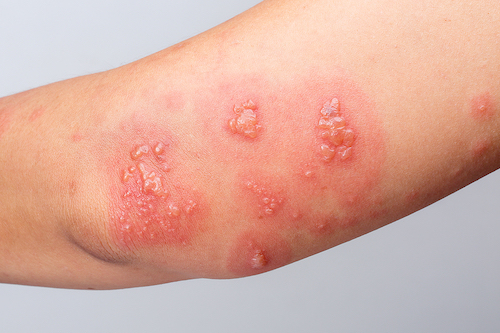 What Does a Poison Ivy Rash Look Like? - GoodRx